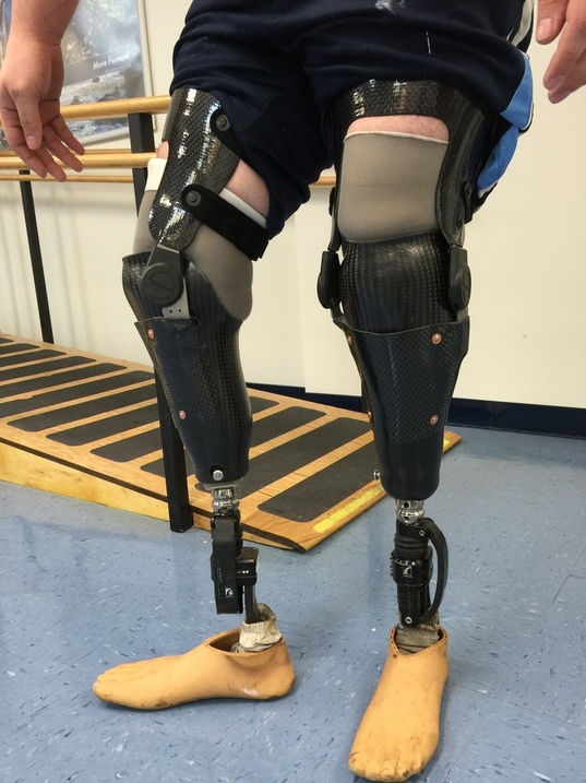 Below prosthesis with joints and thigh corset, Below prosth…