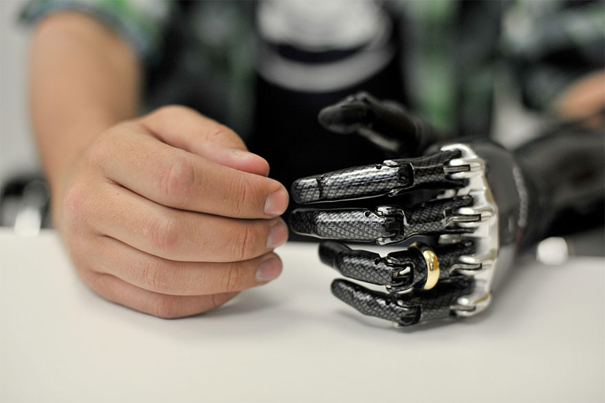 BeBionic myoelectric hand with wedding ring