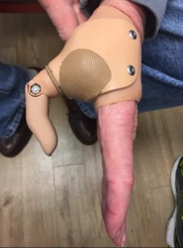 Partial Hand Solutions – Titan Thumb