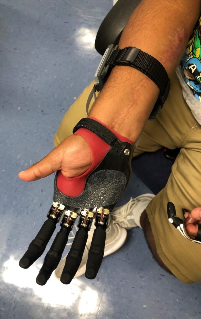 Hand Finger Prosthetics Mcop